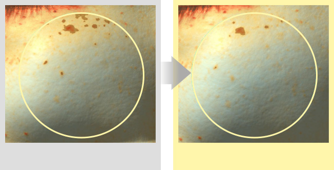 Comparison of size of pigmentation before and after 2 weeks of use