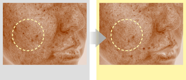 Comparison of number of brown spots before and after 2 weeks of use