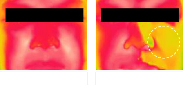 Comparison of cooling/soothing effect(skin temperature decrease) before and after use