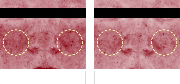 Comparison of sensitive skin soothing effect(redness control) before and after use