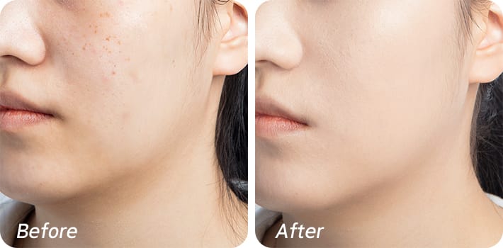 사용 before & after - 얼굴의 붉은 부분들이 매끈하게 커버되는 비교컷