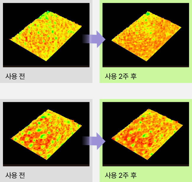 토너 단독 사용 전과 사용 2주 후 모공 입구 타이트닝 개선 비교
