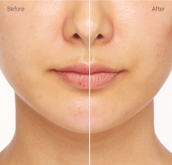 마몽드 하이 커버 크림 코렉터로 피부 붉은기를 커버하는 before & after 모델 연출 gif