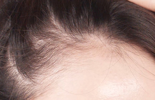 제품 사용 전에는 앞머리 라인이 많이 비어있음