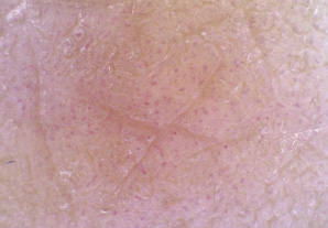 묵은 각질이 눈에 띄게 감소한 피부상태