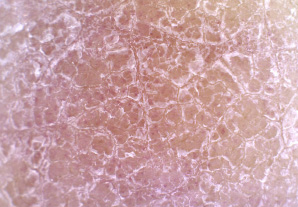 묵은 각질이 하얗게 일어난 피부상태
