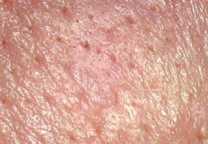 모공 속 검은 노폐물이 깨끗하게 세정된 피부상태