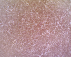 묵은 각질이 하얗게 일어난 피부상태