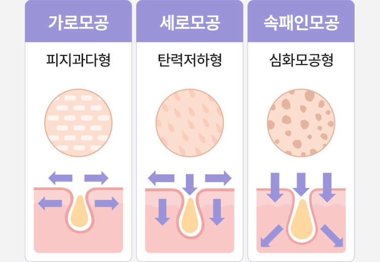 가로모공: 피지과다형/세로모공: 탄력저하형/ 속패인모공: 심화모공형